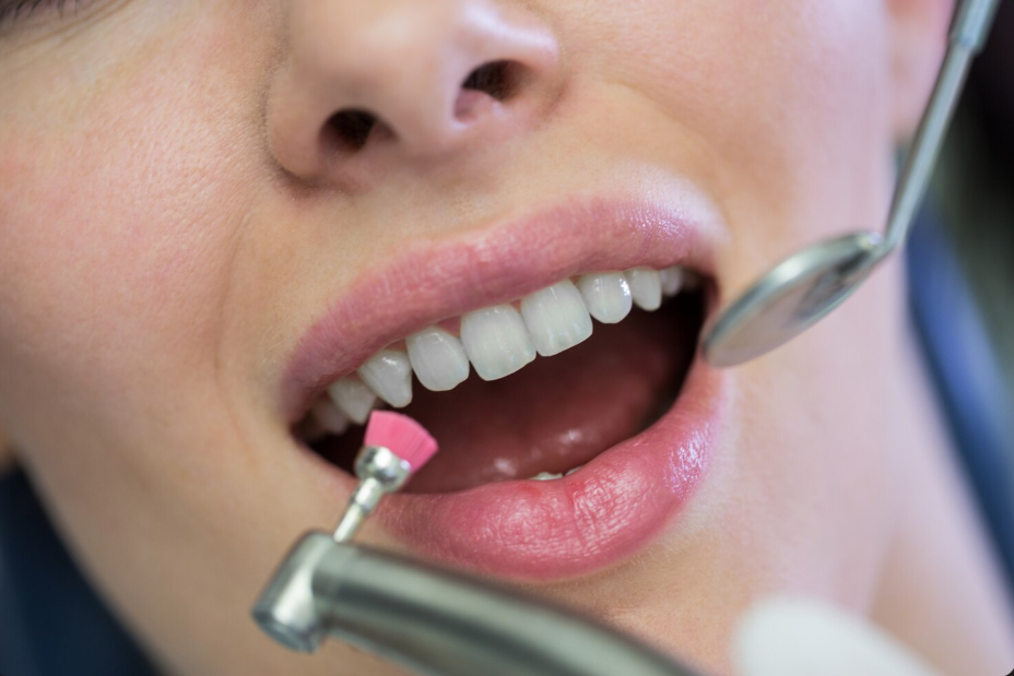 Эстетическая реставрация зубов: современные методы восстановления улыбки